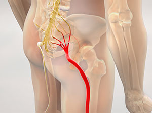 Sciatica Pain
